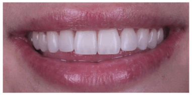 After - Heralds Way Dental