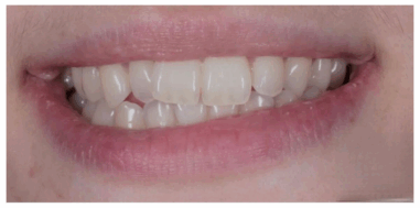 Before - Heralds Way Dental