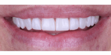After - Heralds Way Dental