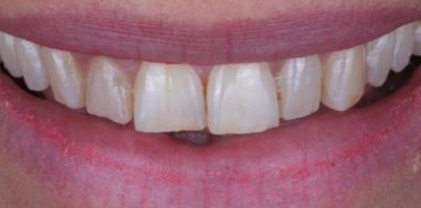 Before - Heralds Way Dental