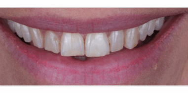 Before - Heralds Way Dental