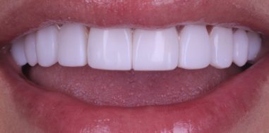 After - Heralds Way Dental