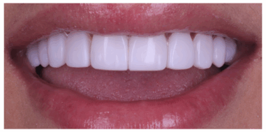 After - Heralds Way Dental