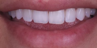 Before - Heralds Way Dental