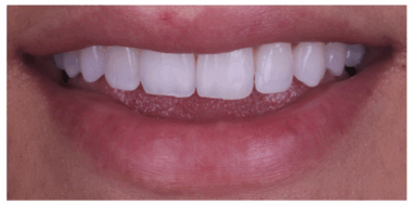 Before - Heralds Way Dental