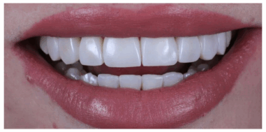 After - Heralds Way Dental