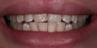 Before - Heralds Way Dental