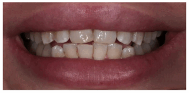 Before - Heralds Way Dental