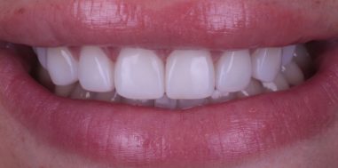 After - Heralds Way Dental