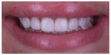 After - Heralds Way Dental