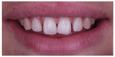 Before - Heralds Way Dental