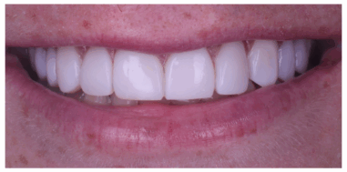 After - Heralds Way Dental