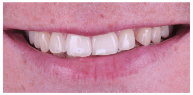 Before - Heralds Way Dental
