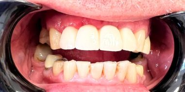 After - Heralds Way Dental