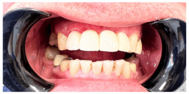 After - Heralds Way Dental
