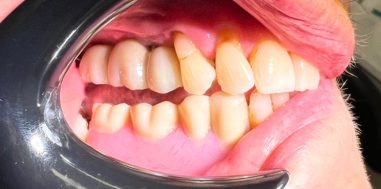 After - Heralds Way Dental