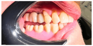 After - Heralds Way Dental