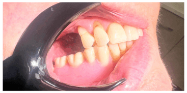 Before - Heralds Way Dental