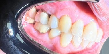 After - Heralds Way Dental