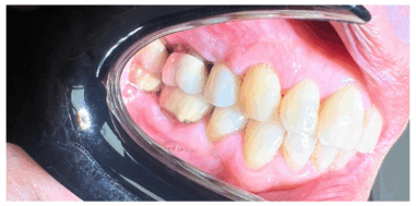 After - Heralds Way Dental