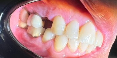 Before - Heralds Way Dental