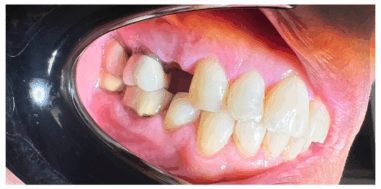 Before - Heralds Way Dental
