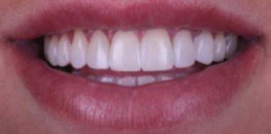After - Heralds Way Dental