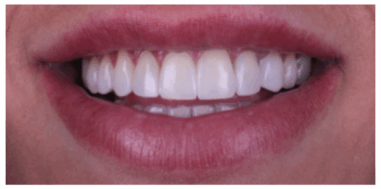 After - Heralds Way Dental