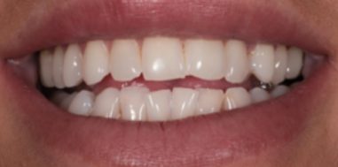 Before - Heralds Way Dental