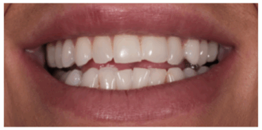 Before - Heralds Way Dental