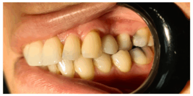 After - Heralds Way Dental