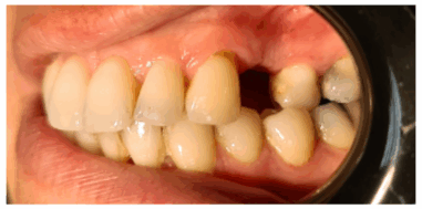 Before - Heralds Way Dental