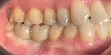 After - Heralds Way Dental