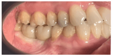 After - Heralds Way Dental