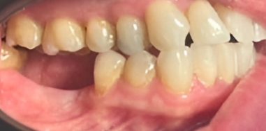 Before - Heralds Way Dental