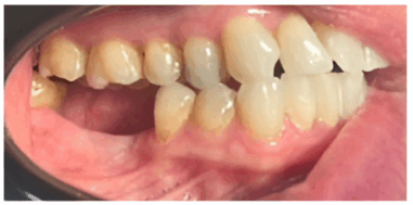 Before - Heralds Way Dental